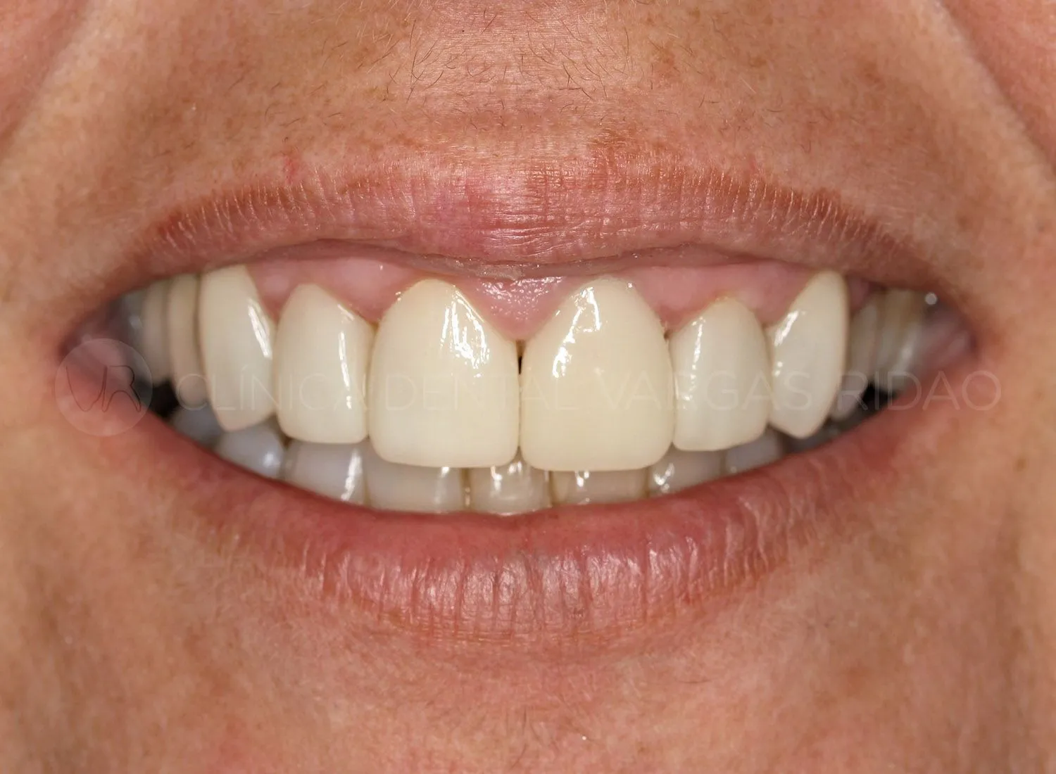 Primer plano de una sonrisa con carillas dentales tratada en la Clínica Vargas Ridao
